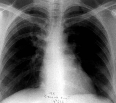 Şenyiğit A, Özateş M, Asan E, Nazaroğlu H, Coşkunsel M. Resim 3. Birinci olgunun 4 lü antitbc tedavinin 6. ayında çekilen akciğer radyografisinde belirgin düzelme mevcut. Resim 5.
