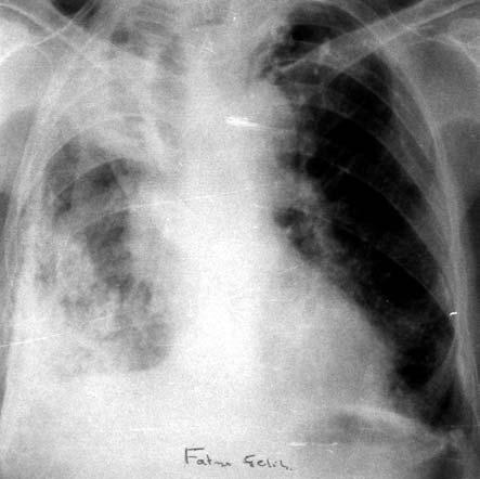 Buna karşın akciğer Tbc sinde belirgin akciğer lezyonu olmadan da hiler veya mediastinal LAP gelişebileceği bildirilmiştir (9).