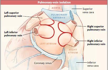 Persistan AF de: İzole pulmoner ven izolasyonu Pulmoner ven izolasyonu +
