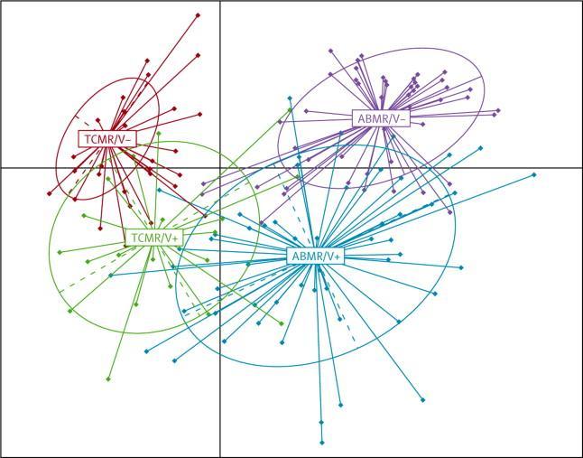 Antikor Aracılı Vasküler Rejeksiyon 1998-2008; 2079 de novo böbrek transplant hastası; bunların 302 si (%15) biopsi-kanıtlı akut rejeksiyon Identification of four distinct rejection patterns