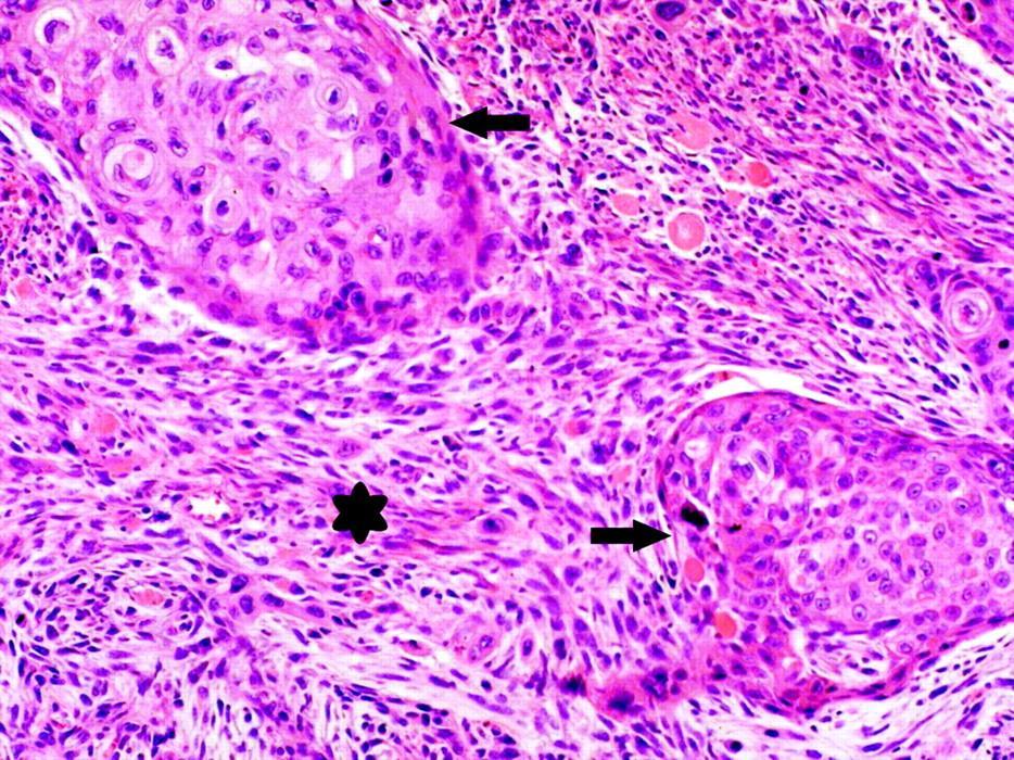 Sarkomatoid karsinom Belirgin skuamöz karsinom Belirgin adenokarsinom + Sarkomatoid görünüm (Nükleer pleomorfizm Malign dev hücreler İğsi hücre morfolojisi) Tanı: Skuamöz hücreli