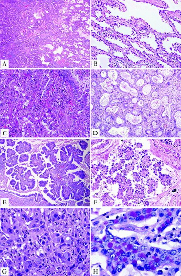 İnvaziv adenokarsinomada majör histolojik patternler 1- Lepidik (A,B)