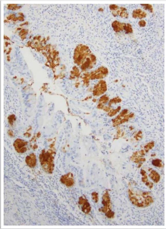 ?. Pilorik gland müsinleriyle (+) (MUC6,