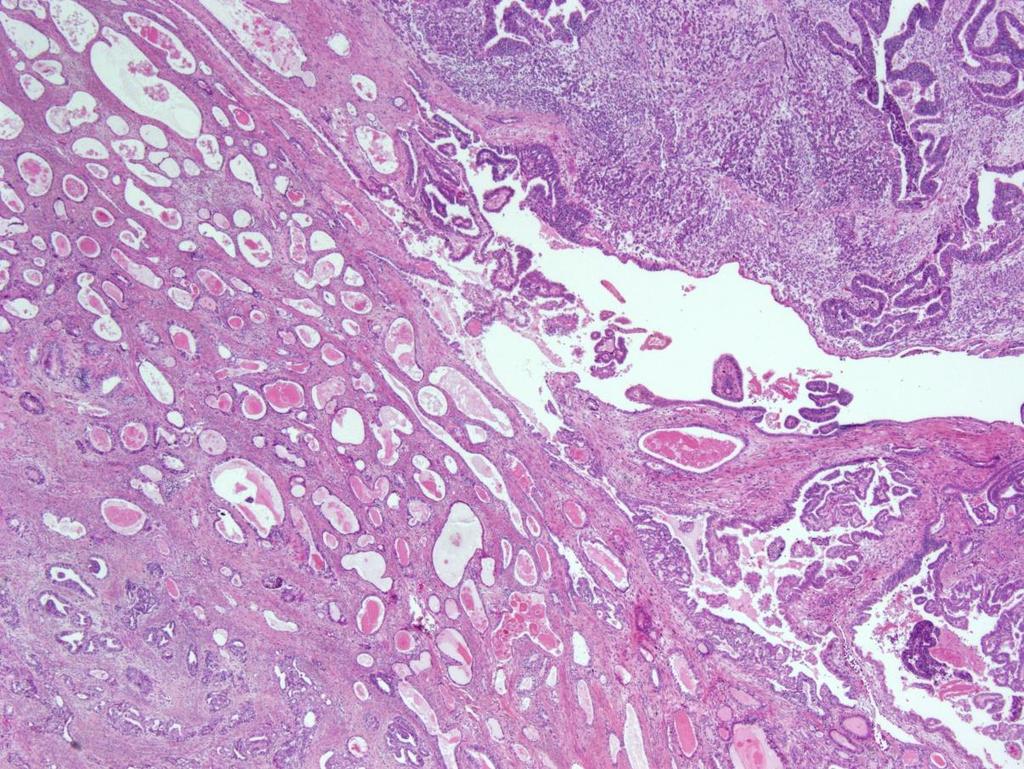 7.Mezonefrik Karsinom HPV ilişkili değildir Nadir varyant Makroskopi; Posterior servikal duvar lateralinde gelişir. Alt uterin segmenti tutar. Histoloji; Farklı karakterlerde glandlar vardır.