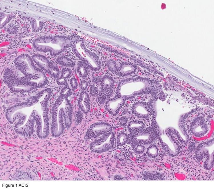 Adenokarsinoma İnsitu (AİS) Küçük