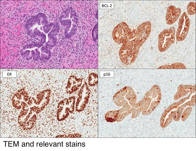 AIS yu taklit eden lezyonlar Tuboendometrioid metaplazi