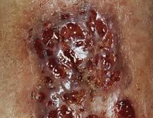 %10-20 hastada barsak dışı bulgular Artrit %19 Dermatolojik %4 Eritema Nodosum Pyoderma gangrenosum Hepatobilier Perikolanjit Kronik aktif hepatit Kolanjiokarsinom %33