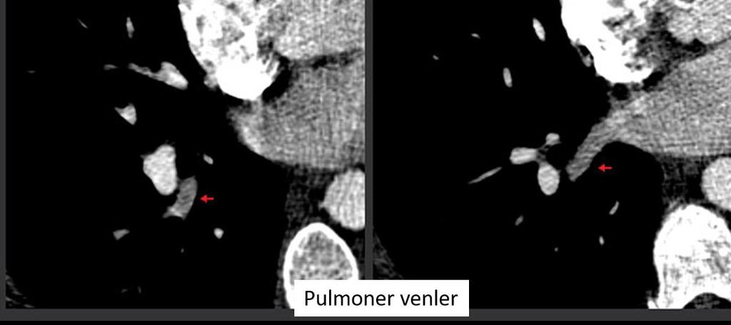 PULMONER TROMBOEMBOLİ