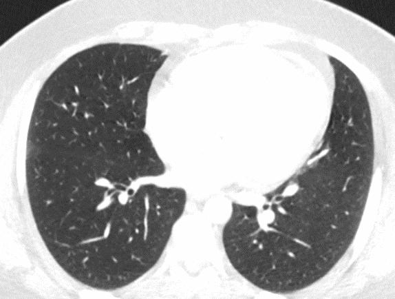 Hangi görüntü için pulmoner