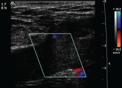 US / Doppler US DVT araştırılır US