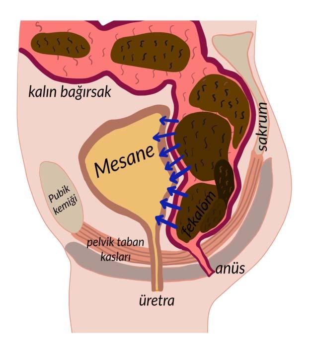 Mesane disfonksiyonu düzeltilemeyen çocukların %50 sinde dışkılama bozuklukları olduğu bilinmektedir Kabızlık normal mesane fonksiyonlarını inhibe ederek