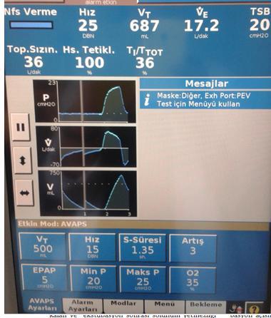 AVAPS IPAP max 1-5 cmh 2 O over 1