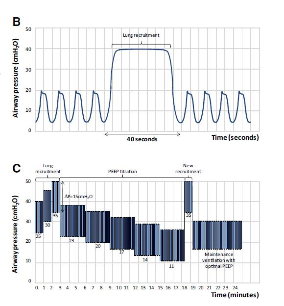 ARDS-Recruitment Manevrası Sustained inflation recruitment maneuver cpap:30-40cmh20,30-40 sn Stepwise