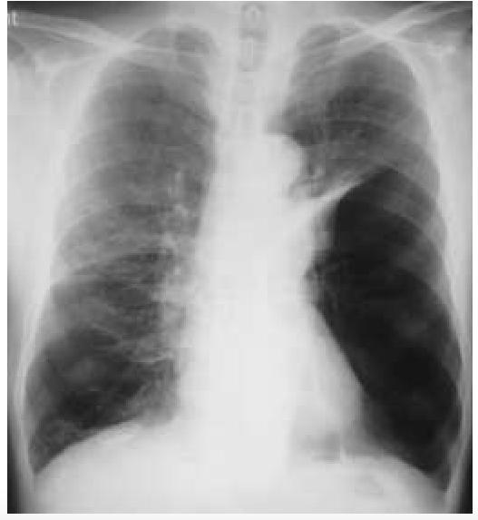 Akciğer Grafisinde