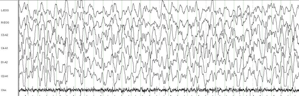 EOG sadece frontal EEG