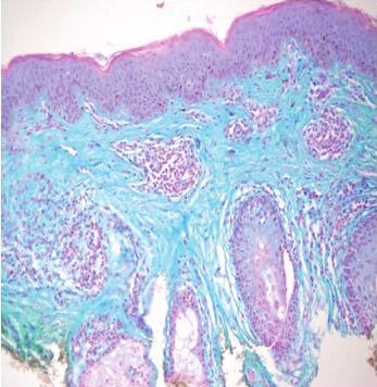 Histopatolojik olarak likenoid interfaz dermatiti, süperfisyel perivasküler ve ile dermal müsinozis saptanmıştır. Dermiste LV paterni bulunmaktadır (Şekil 3).