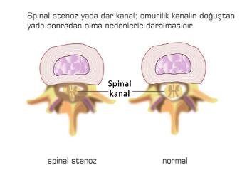 2. Omurga Kanalının Darlığı- Spinal Stenoz: Yaşa bağlı olarak omuriliği çevreleyen kanalın etrafındaki faset eklemlerde ve disklerde kireçlenme gelişir ve yavaş yavaş kanalı daraltmaya başlar.