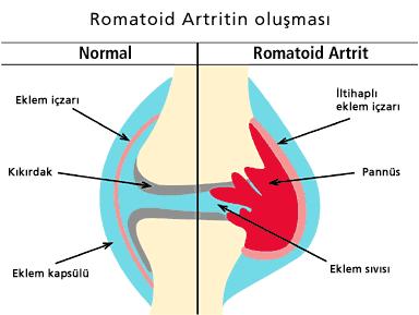 Pannüs Eklem sıvısını üreten hücrelerin kontrolsüz bir