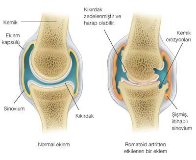 5) subkondral destrüksiyon eklemdeki subkondral destrüksiyondan sonra subkondral skleroz meydana gelir ve eklem dışındaki kemikte osteoporoz görülür.