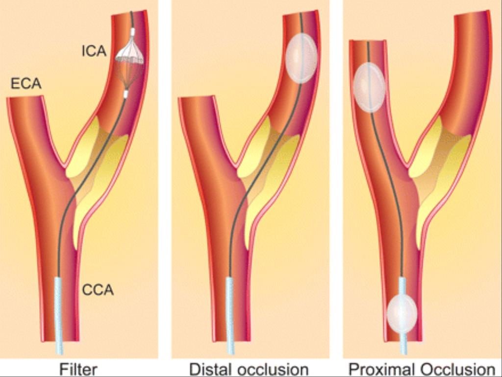 EPD çeşitleri Proximal Proximal oklüzyon balonları Akım oklüzyon cihazları Akım çevirici cihazlar Distal Filtreler Oklüzyon