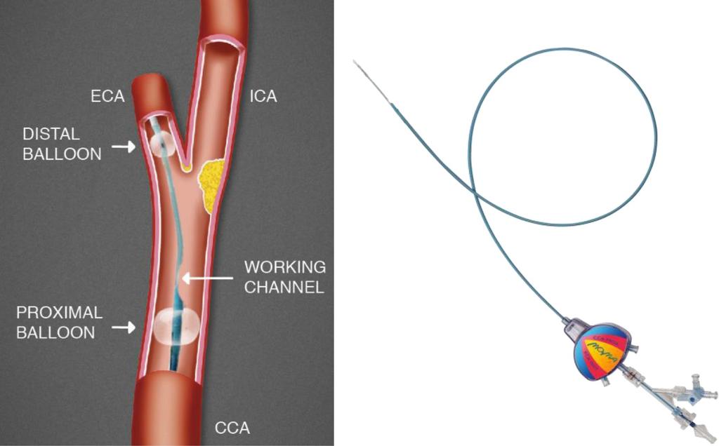 Proximal koruma Avantajları Akım yönündeki değişiklik; Lezyondan ilk geçişe gerek kalmaz 3 çalışma ve meta-analizde; 30