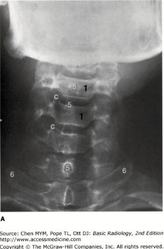 Corpus vertebrae Processus uncinatus