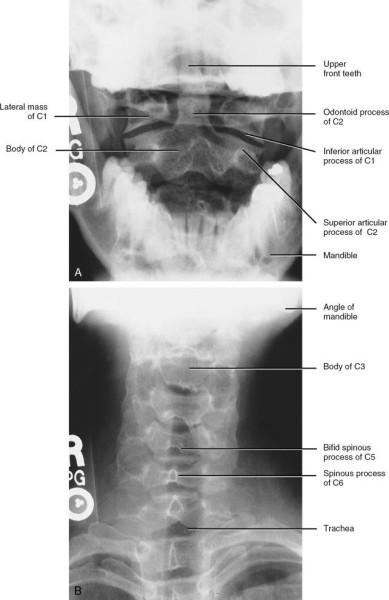 F Ön dişlerin üstü C1 lateral gövde C2 gövde Odontoid C1
