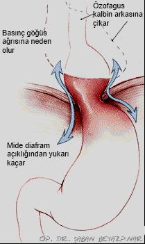 farkı nedeni ile mide asit salgısı özofagusa kaçar.