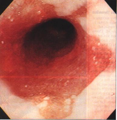 GÖRH ın özofagustaki etkileri nelerdir?