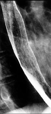 röntgen filmleri ile özofagus, mide ve duodenumun