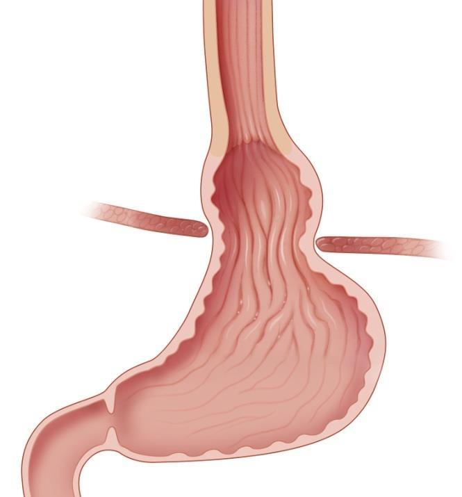 ANATOMİ Diyafram hiatusu (Renkli alan) Özofagusun diaframdan geçip mide ile birleştiği yerdir. Karın boşluğuna geçen diaframın etrafını saran kas liflerinden oluşur.