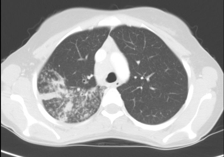 halsizlik, PPD: 17 mm, QTF: pozitif,