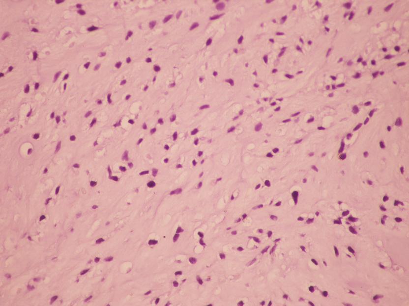 Sol üst skapula dorsalinden alınan biyopsi kondroid tümör şeklinde