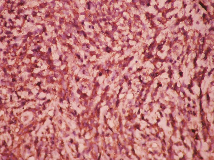 BİLATERAL AKCİĞER METASTAZI İLE BİRLİKTE İSKELETDIŞI YERLEŞİM a b c Resim 5 a. (S100) (X400) Tümör hücreleri diffüz (+), b. (Vimentin X400) (+), c.