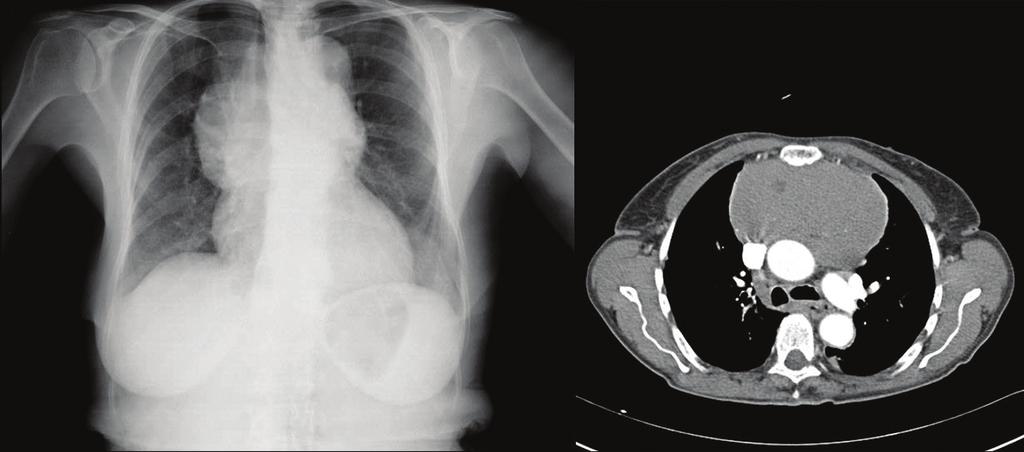 BÖLÜM 07 Bilgisayarlı Tomografi 51 A B Resim 8. İnvaziv timoma. A. Radyografide üst mediyastende lobüle görünüm, B.