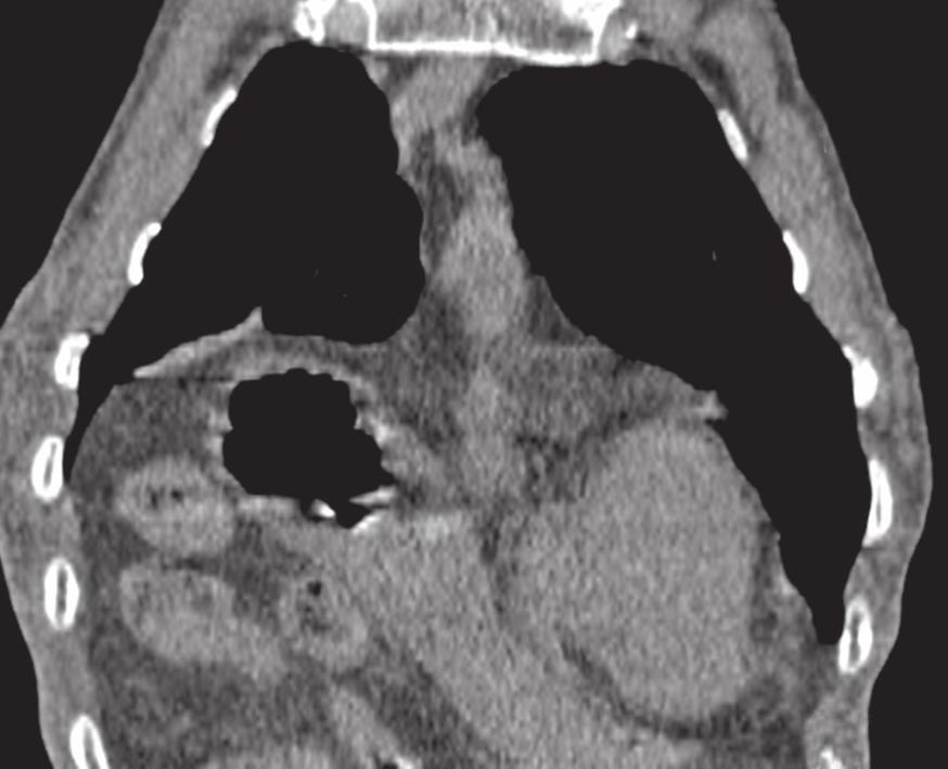 BÖLÜM 07 Bilgisayarlı Tomografi 53 Resim 11. Diyafragma hernisi. Koronal reformat BT de midenin Larrey aralığından kardiyofrenik açıya doğru herniye olduğu görülüyor (ok).