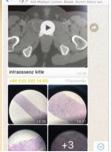 Kemik Yumuşak Doku Patolojisi Çalışma Grubu 23 Mart ta Uzmanıyla Mikroskop Başındayız: