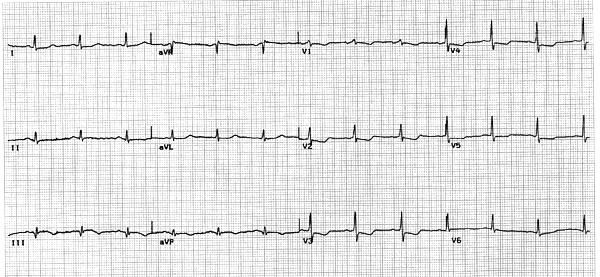 Örnek ekg