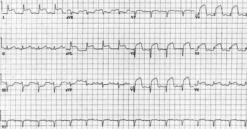 Örnek ekg