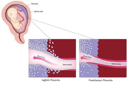 Preeklampsi Tüm dünyada fetal ve maternal morbidite ve mortalitenin önemli nedenidir.