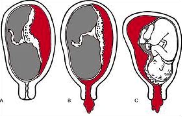 Dekolman plasenta Plasentanın erken dönemde uterus iç tabakasından ayrılmasıdır. Gebelerin %1 de görülür. En sık risk faktörü hipertansiyondur.