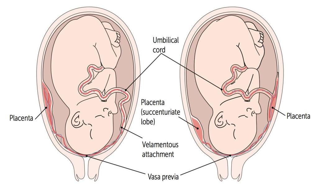 Vaza previa 2500 doğumda bir görülür Umblikal kord plasenta içerisine girmeden önce fetal membranların içerisinden geçmektedir.