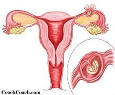 Ektopik Gebelik Fertilize ovumun endometriyal kavite dıģında yerleģmesi Ġlk