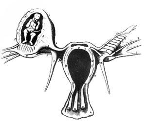 Ektopik Gebelik % 90 olguda karın ağrısı, % 50-80 olguda vaginal kanama, Hipovolemi, Ģok bulguları görülebilir.