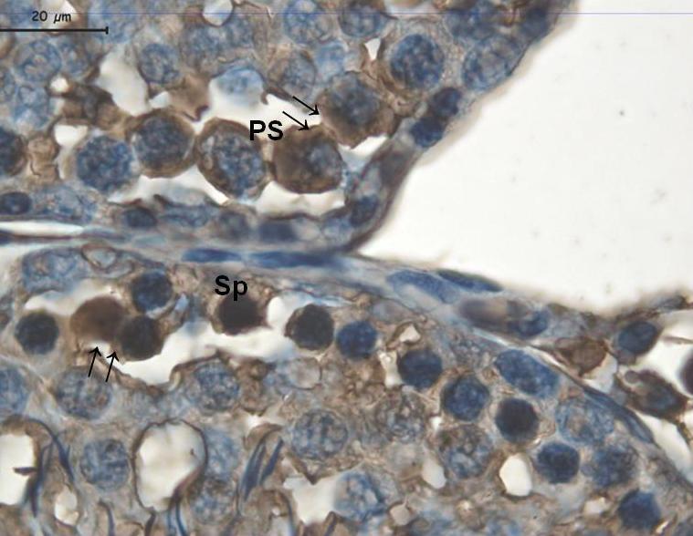 Resim 35: 1000 mg/kg DBP uygulanan grupta hücre-hücre bağlantılarının oluģtuğu alanda ( ), çekirdek, sitoplazma ve zarda
