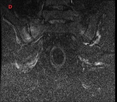 Servikal lateral grafi. Resim 2. Dorsal lateral (A) ve AP (B) grafiler Hasta son birkaç haftadır bel ve kalça bölgesi ağrısından yakınmaktadır.