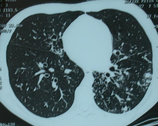 KF Gen Mutasyonu Kistik Fibroziste Akciğer Hastalığının