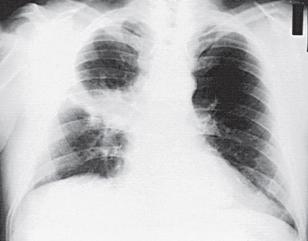 Klinik Formlar Pnömonik tularemi Bakterinin kan yoluyla ya da kontamine aerosollerin inhalasyonuyla akciğerle ulaşması Klinik belirtiler Ateş, öksürük,