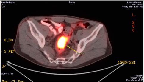 (SUVmax:7.04), majör pelvis girişinde orta hattın sağında 8 mm batın ön duvarı sağ lateralinde peritoneal yüzeyde 9 mm çapında hipermetabolik nodüler implantlar (SUVmax:3.50) tespit edildi.