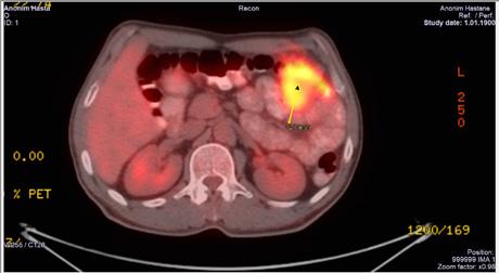 Peritoneal karsinomatozis indeksi (PKİ):13 olarak hesaplandı. Yapılan operasyonda PET te tanımlı sol kolondaki 2.